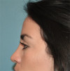 Rhinoplasty Patient #1 After Photo Thumbnail # 4