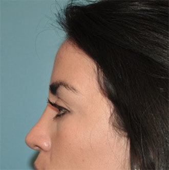 Rhinoplasty Patient #1 After Photo # 4