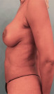 Breast Augmentation (Implants) Patient #7 After Photo Thumbnail # 6