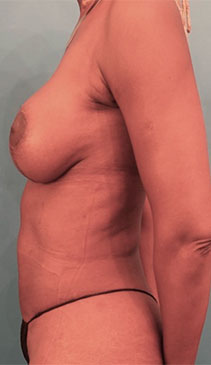 Breast Augmentation (Implants) Patient #7 After Photo # 6