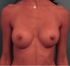 Breast Augmentation (Implants) Patient #1 After Photo Thumbnail # 2