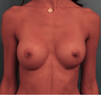 Breast Augmentation (Implants) Patient #1 After Photo # 2