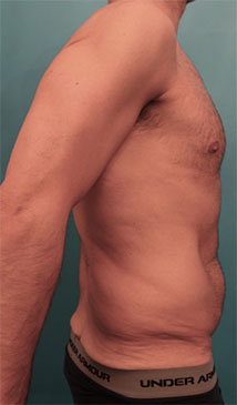 Abdominoplasty/ Tummy Tuck Patient #3 Before Photo # 5