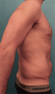 Male Abdominoplasty/Tummy Tuck Patient #1 Before Photo Thumbnail # 5