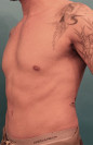 Male Abdominoplasty/Tummy Tuck Patient #2 After Photo Thumbnail # 4