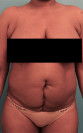 Abdominoplasty/ Tummy Tuck Patient #4 Before Photo Thumbnail # 1