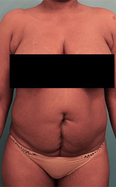 Abdominoplasty/ Tummy Tuck Patient #4 Before Photo # 1