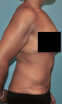 Abdominoplasty/ Tummy Tuck Patient #6 After Photo # 6