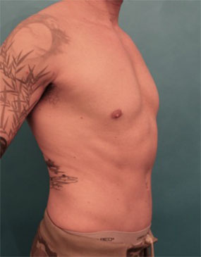 Male Abdominoplasty/Tummy Tuck Patient #2 After Photo # 6