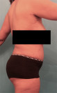 Abdominoplasty/ Tummy Tuck Patient #7 After Photo Thumbnail # 10