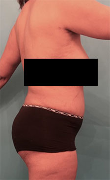 Abdominoplasty/ Tummy Tuck Patient #7 After Photo # 10