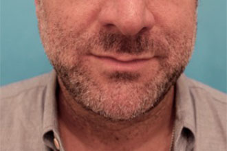 Male Kybella Patient #5 After Photo # 2