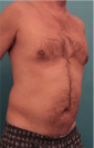 Male Liposuction Patient #2 Before Photo Thumbnail # 9