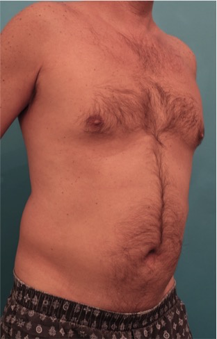 Male Liposuction Patient #2 Before Photo # 9