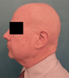 Male Laser Resurfacing Patient #1 After Photo Thumbnail # 6