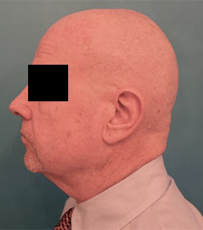 Male Laser Resurfacing Patient #1 After Photo # 6