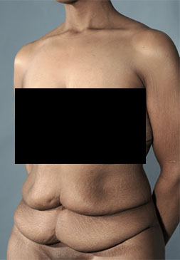 Abdominoplasty/ Tummy Tuck Patient #6 Before Photo # 7