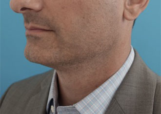 Male Kybella Patient #1 After Photo # 8