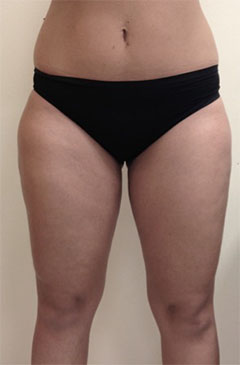 Liposuction Patient #7 After Photo # 2
