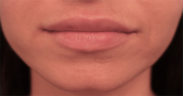 Lip Filler Patient #5 After Photo # 2