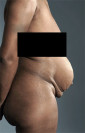 Abdominoplasty/ Tummy Tuck Patient #8 Before Photo Thumbnail # 9