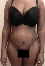 Abdominoplasty/ Tummy Tuck Patient #8 After Photo Thumbnail # 2