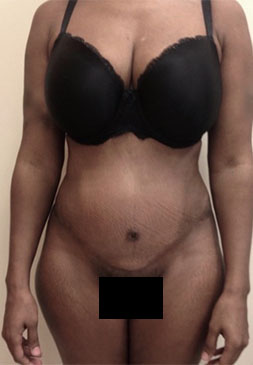 Abdominoplasty/ Tummy Tuck Patient #8 After Photo # 2