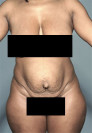 Abdominoplasty/ Tummy Tuck Patient #8 Before Photo Thumbnail # 1