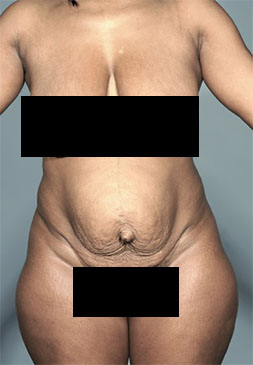 Abdominoplasty/ Tummy Tuck Patient #8 Before Photo # 1