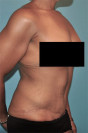 Abdominoplasty/ Tummy Tuck Patient #6 After Photo Thumbnail # 4