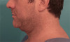 Male Kybella Patient #5 Before Photo Thumbnail # 3