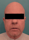 Male Laser Resurfacing Patient #1 After Photo Thumbnail # 2