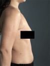 Liposuction Patient #6 Before Photo Thumbnail # 5