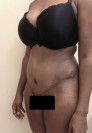 Abdominoplasty/ Tummy Tuck Patient #8 After Photo Thumbnail # 4