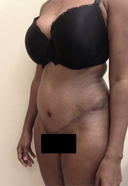 Abdominoplasty/ Tummy Tuck Patient #8 After Photo # 4