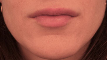 Lip Filler Patient #3 After Photo # 2