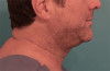 Male Kybella Patient #5 Before Photo Thumbnail # 5