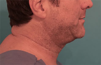 Male Kybella Patient #5 Before Photo # 5