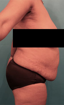 Abdominoplasty/ Tummy Tuck Patient #7 Before Photo # 9