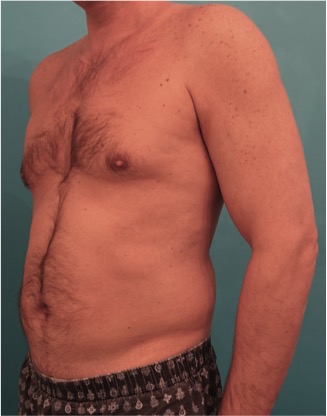 Male Liposuction Patient #2 Before Photo # 5