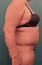 Abdominoplasty/ Tummy Tuck Patient #9 After Photo Thumbnail # 10