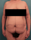 Abdominoplasty / Tummy Tuck Patient
