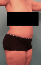 Abdominoplasty/ Tummy Tuck Patient #7 After Photo Thumbnail # 8