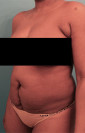 Abdominoplasty/ Tummy Tuck Patient #4 Before Photo Thumbnail # 3
