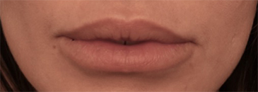 Lip Filler Patient #4 Before Photo # 1