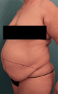 Abdominoplasty/ Tummy Tuck Patient #9 Before Photo Thumbnail # 3