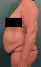 Abdominoplasty/ Tummy Tuck Patient #9 Before Photo Thumbnail # 5