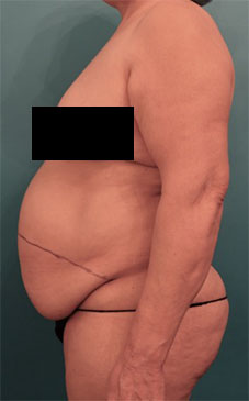 Abdominoplasty/ Tummy Tuck Patient #9 Before Photo # 5