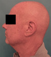 Male Laser Resurfacing Patient #1 Before Photo Thumbnail # 5
