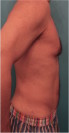 Male Liposuction Patient #2 After Photo Thumbnail # 12